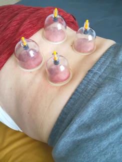 Cupping Treatments