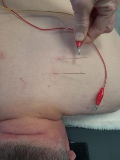 acupuncture